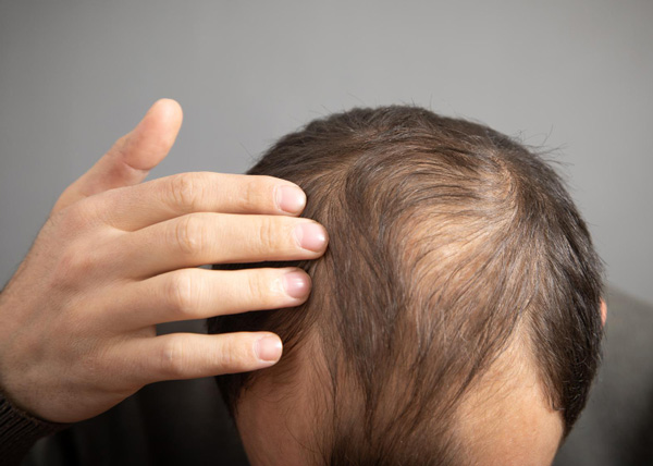 alopécie soins cuir chevelu et cheveux pour perte de cheveux suite à un facteur environnemental