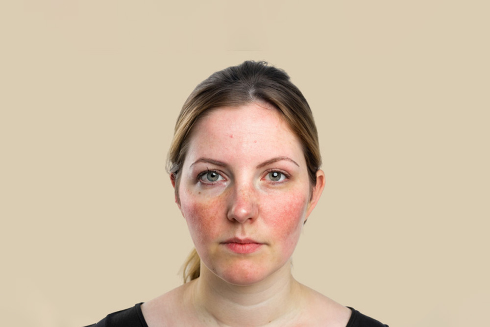 soins visages dermo esthétique contre les marques de couperose, rosacées