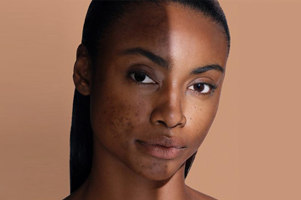 soin du visage pour effacer les taches pigmentaire par dermeclat à Bouc Bel air méthode cosmelan